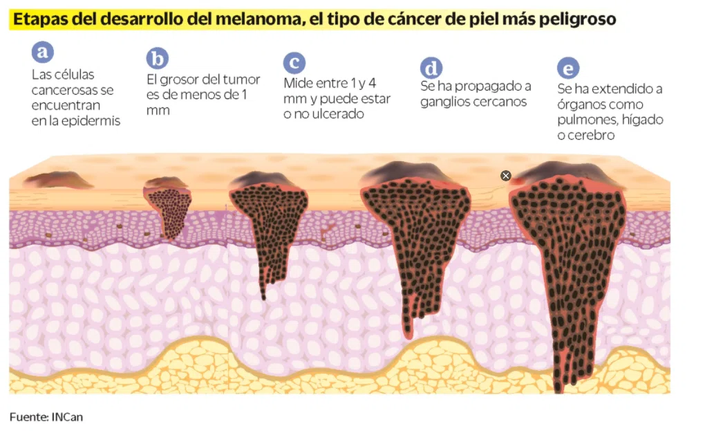 Melanoma.png